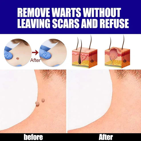 Warts Remover Cream